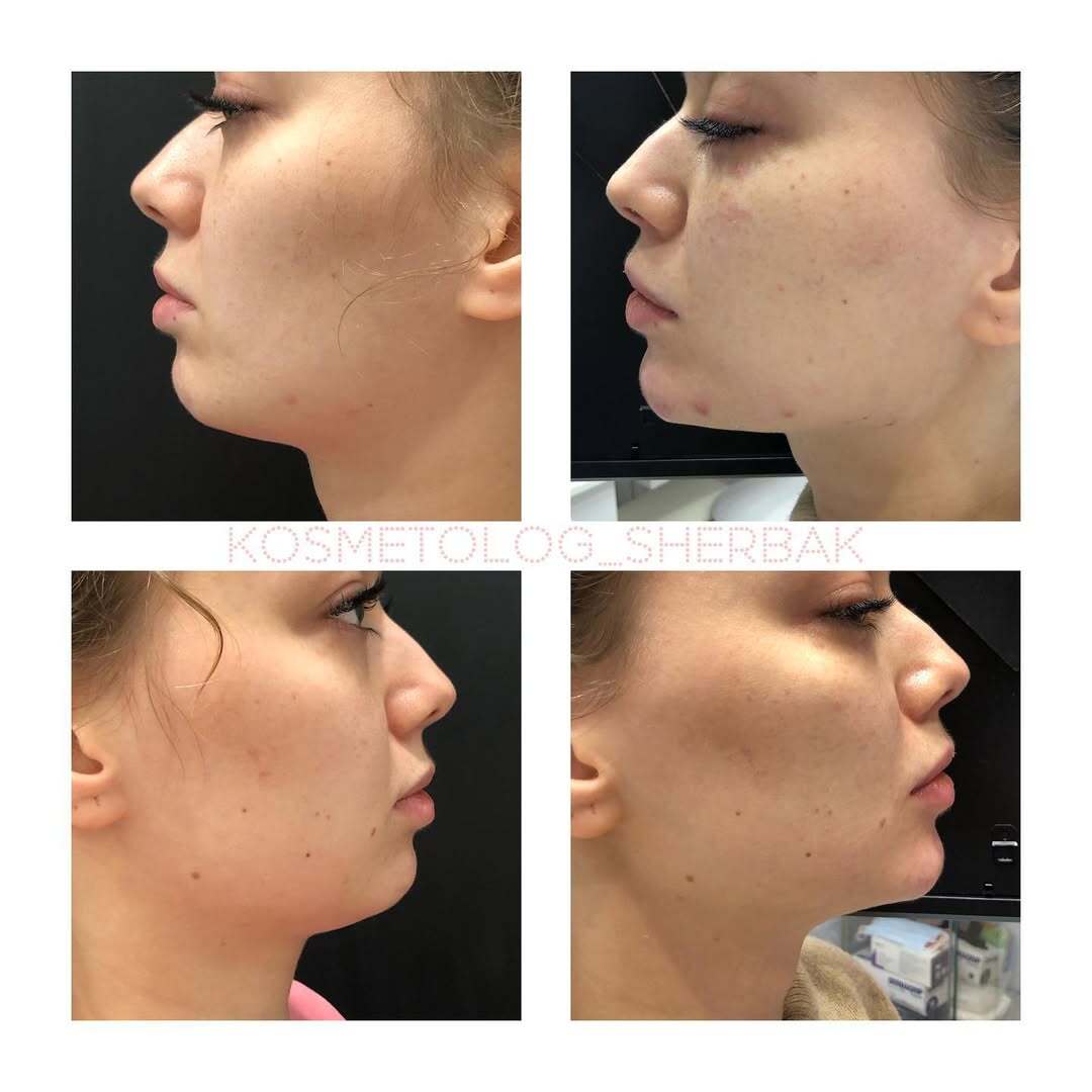 Контурная пластика лица в клинике PradusCOSMO, Санкт-Петербург. Естественный результат без эффекта переделанного лица