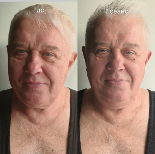 Коррекция шеи и декольте