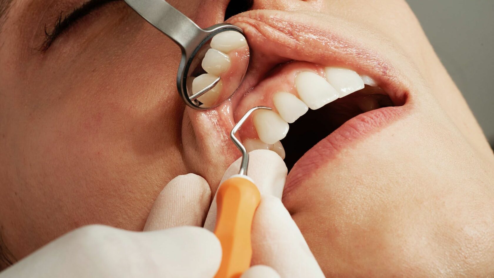 Флюс зуба: что это и как лечить