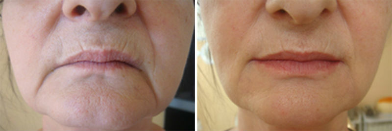 Фото 2. Поднятие уголков рта с помощью филлера до и после