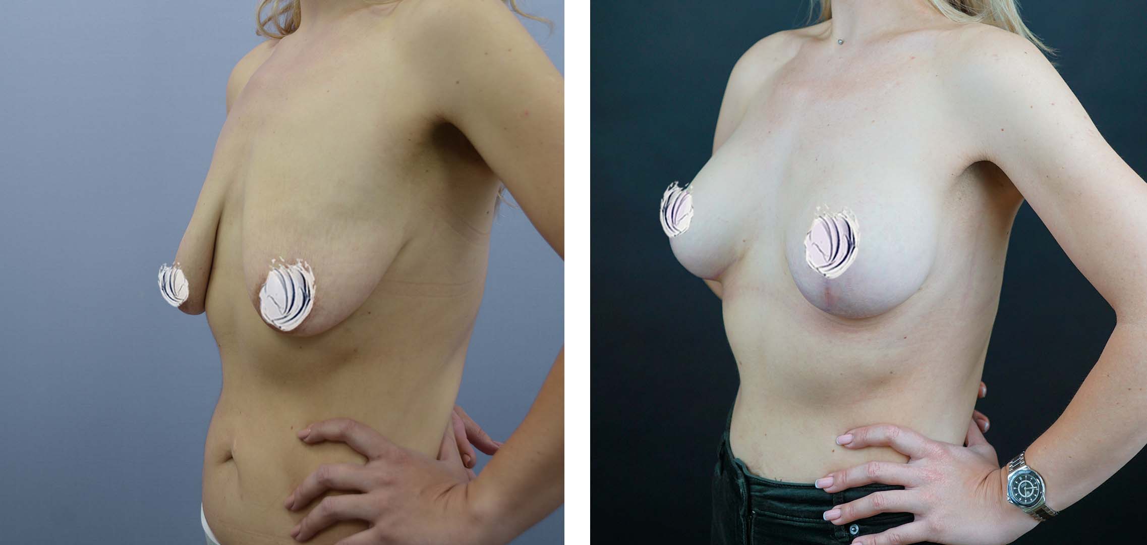 как восстановить одну грудь после кормления фото 118