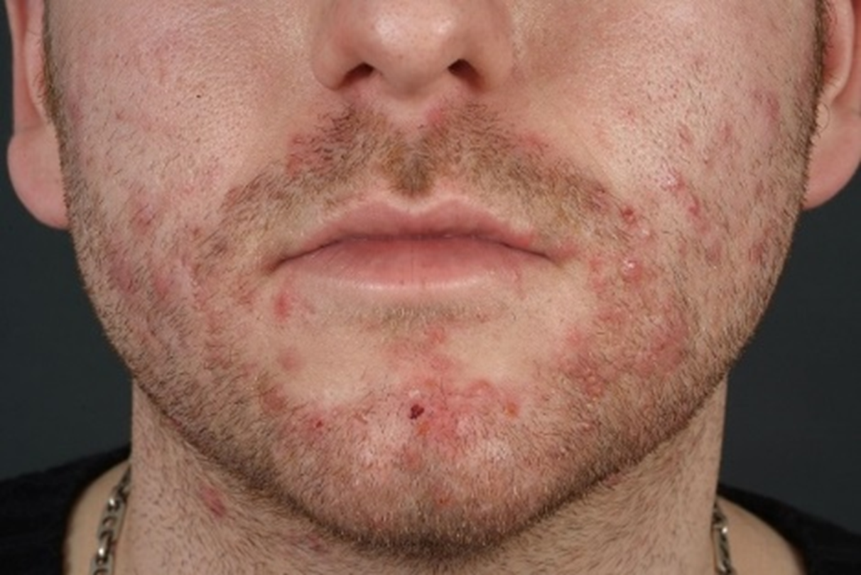 Заболевания кожи лица: виды, причины, лечение