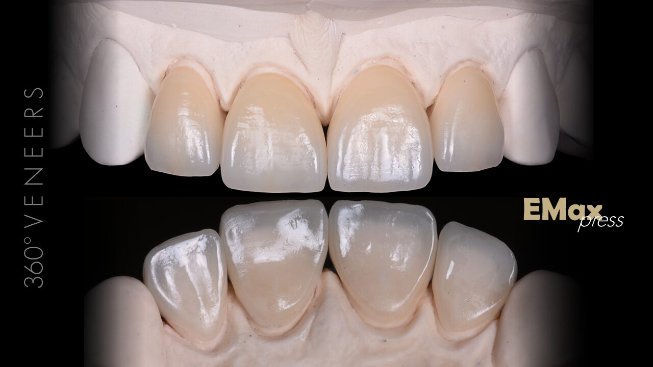 LIVEdemonstration by Didier Dietschi Tooth Wear