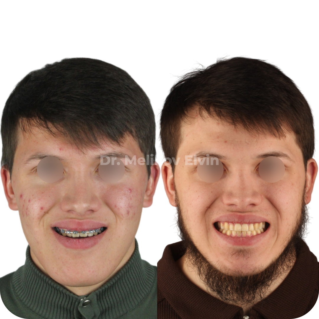 Мезиальный прикус