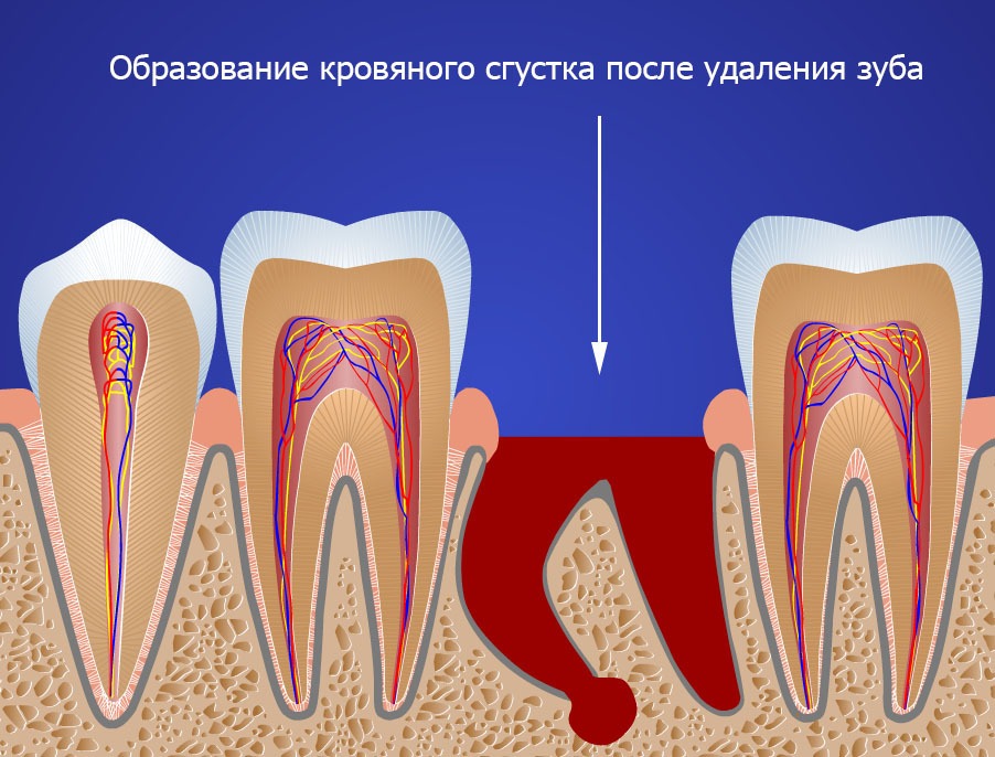 Как проходит удаление зуба?