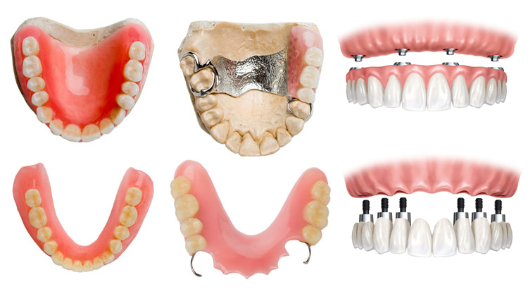 Как изготавливают зубные протезы - особенности технологий и материалов