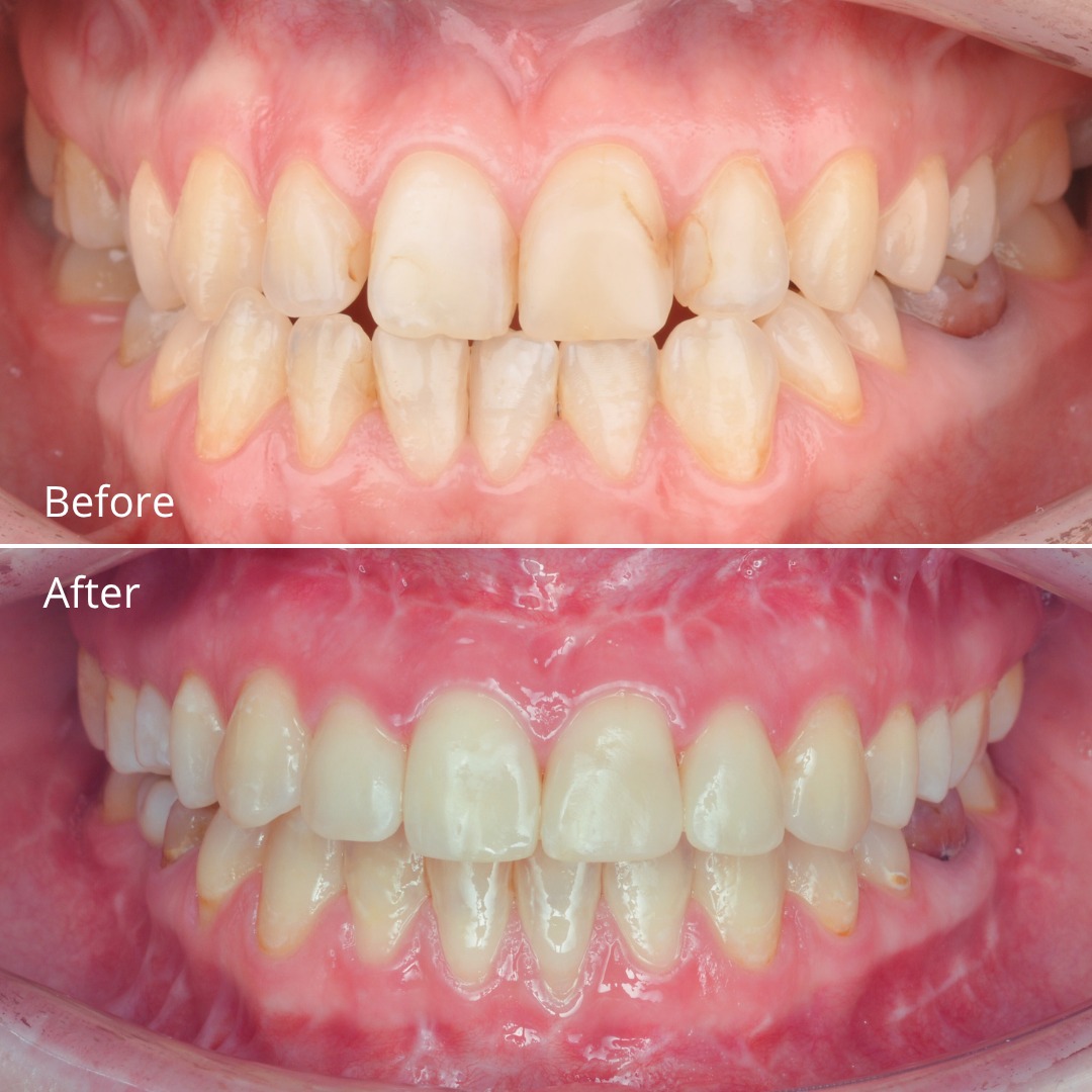 Stage showing the arches prepared ahead of orthognathic surgery — photo 3 of 5