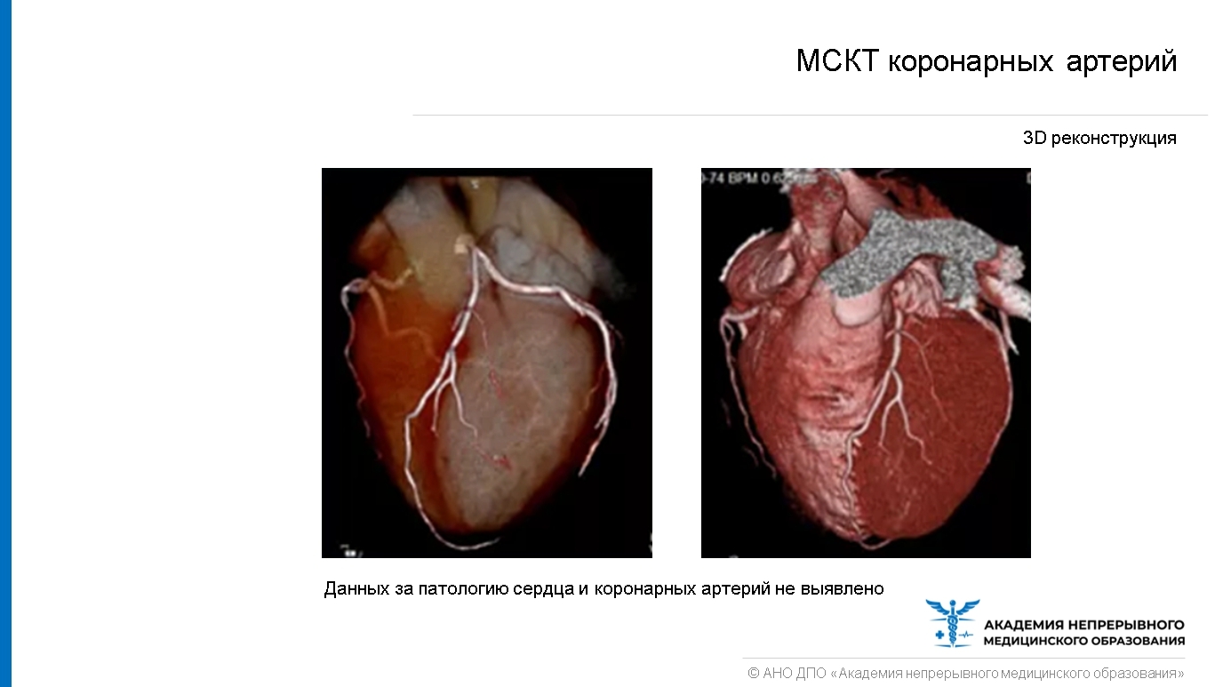 Мультиспиральная компьютерная томография коронарных артерий что это