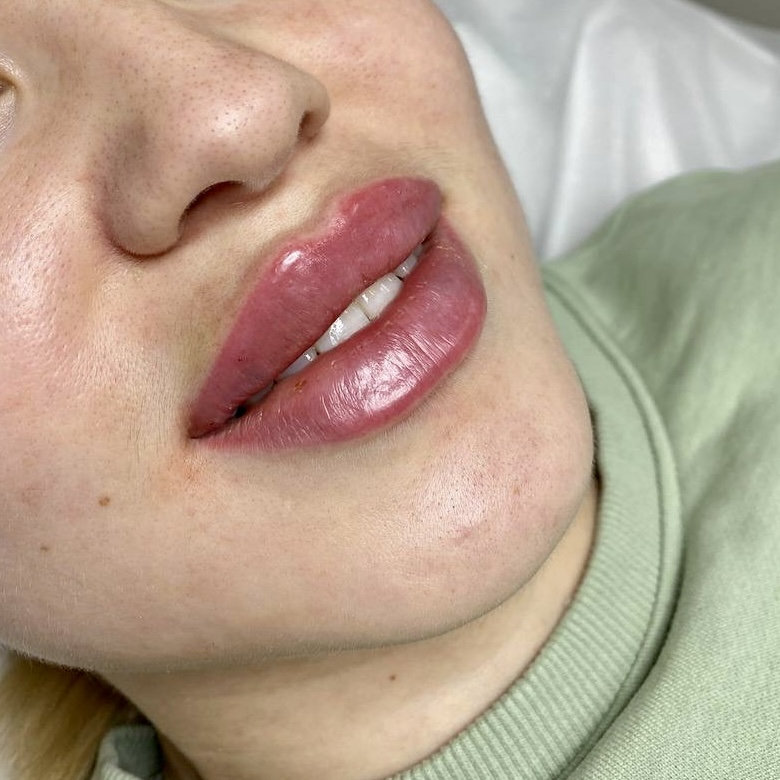 Контурная пластика губ от доктора Гульнары Курталиевой в клинике BeBeauty