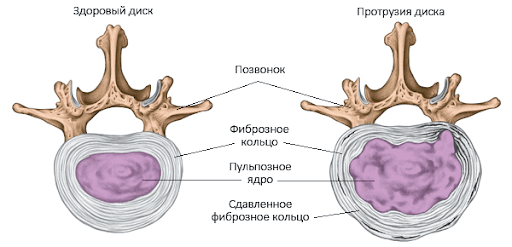 Протрузия и теннисный мячик