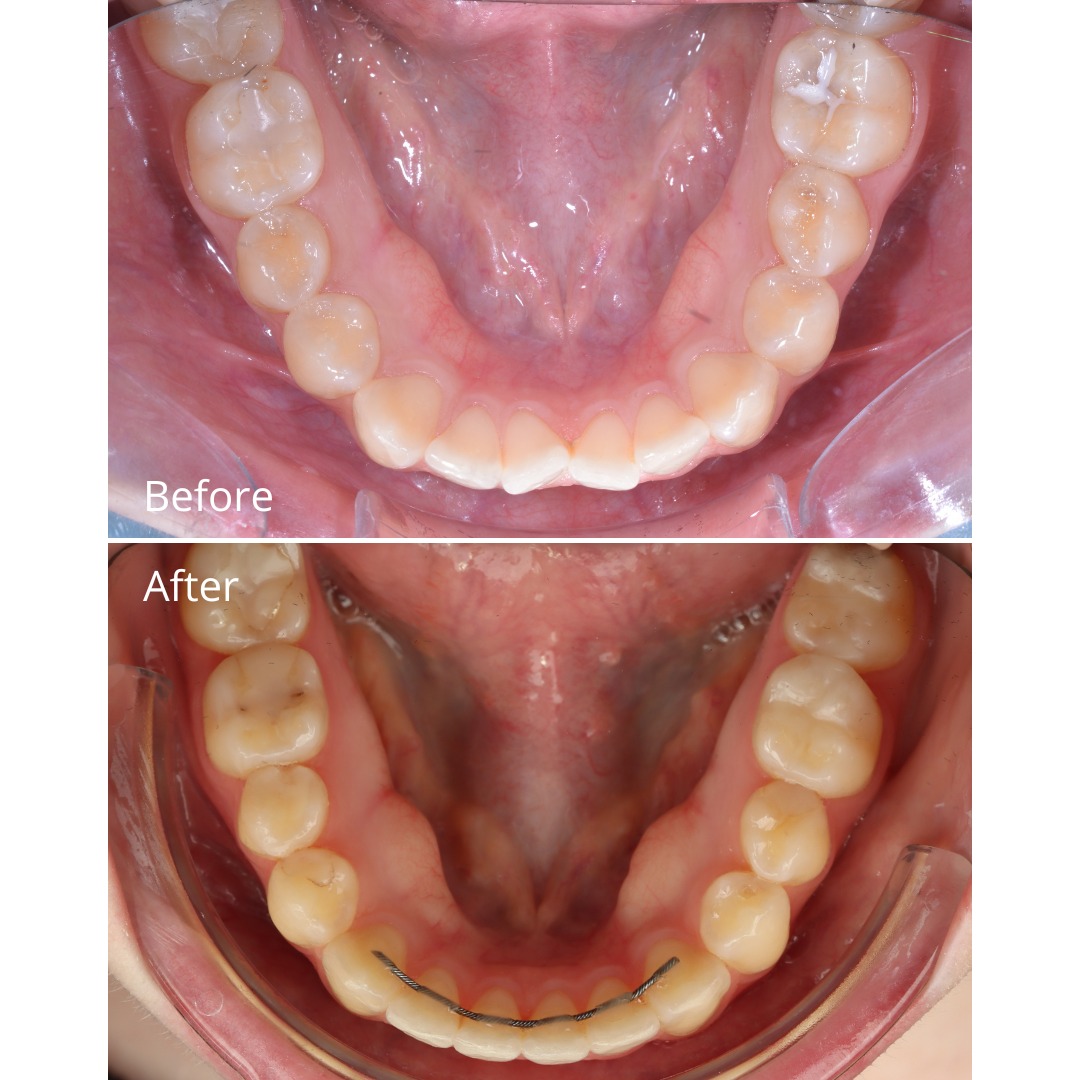 Stage photo showing near-final tooth alignment before finishing — photo 4 of 5