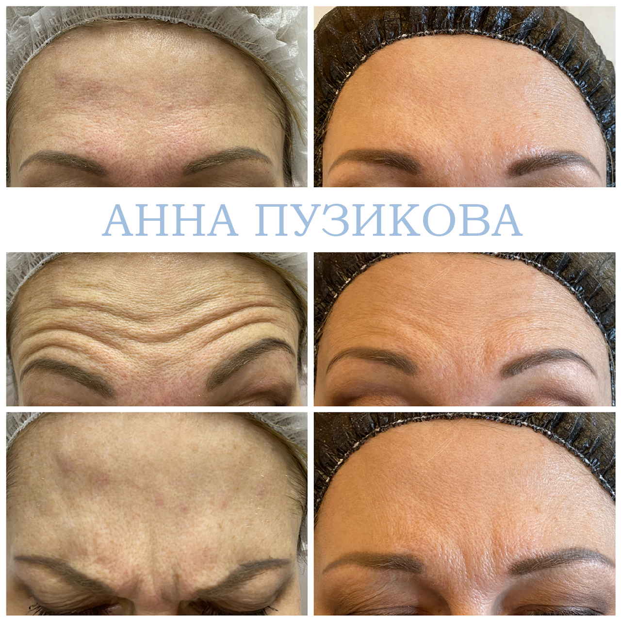 Результат ботулинотерапии — коррекция мимических морщин на лбу и в области глаз. Косметолог Пузикова Анна Анатольевна, Санкт-Петербург