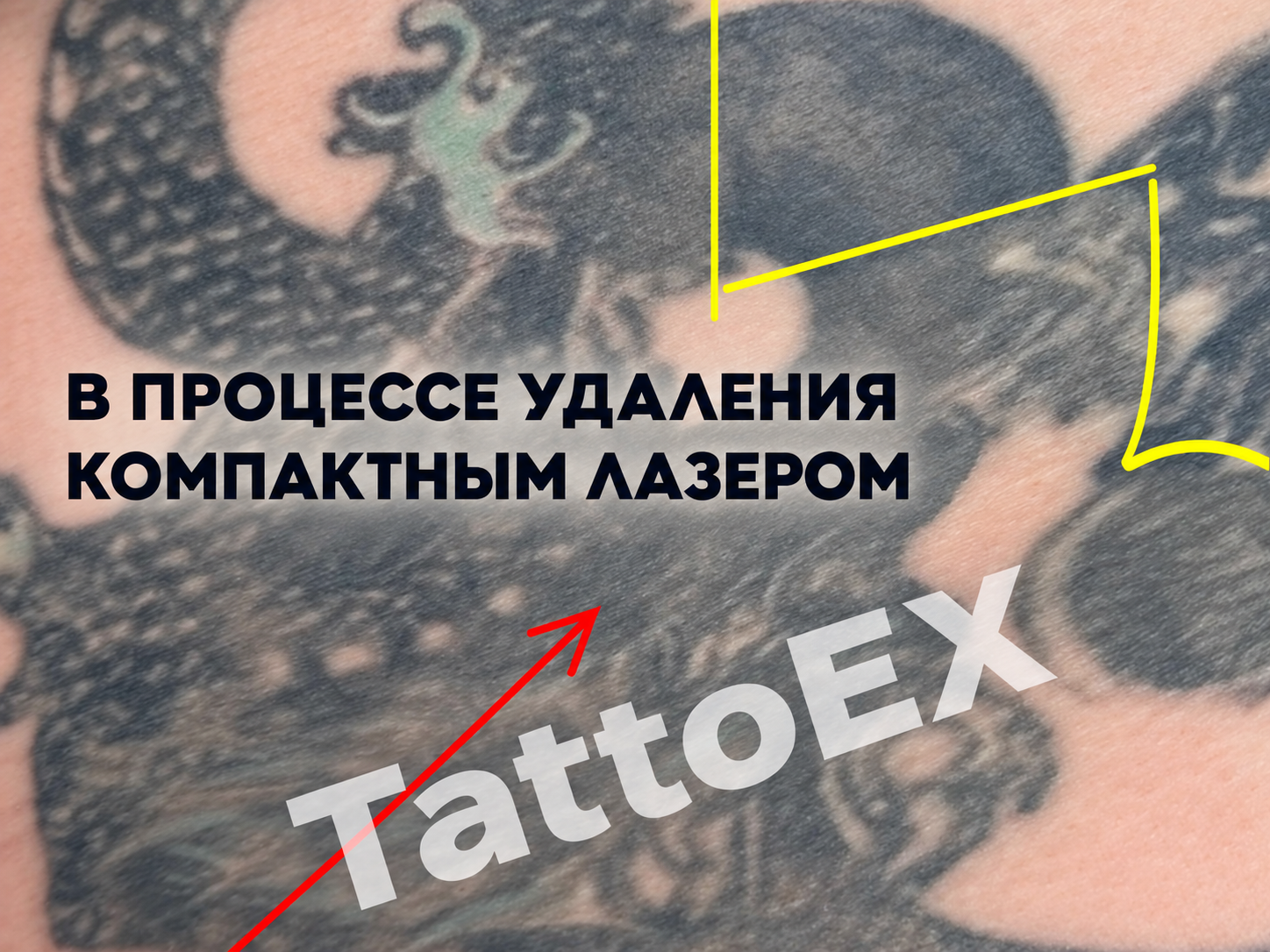 После удаления тату лазером — участок после компактного аппарата