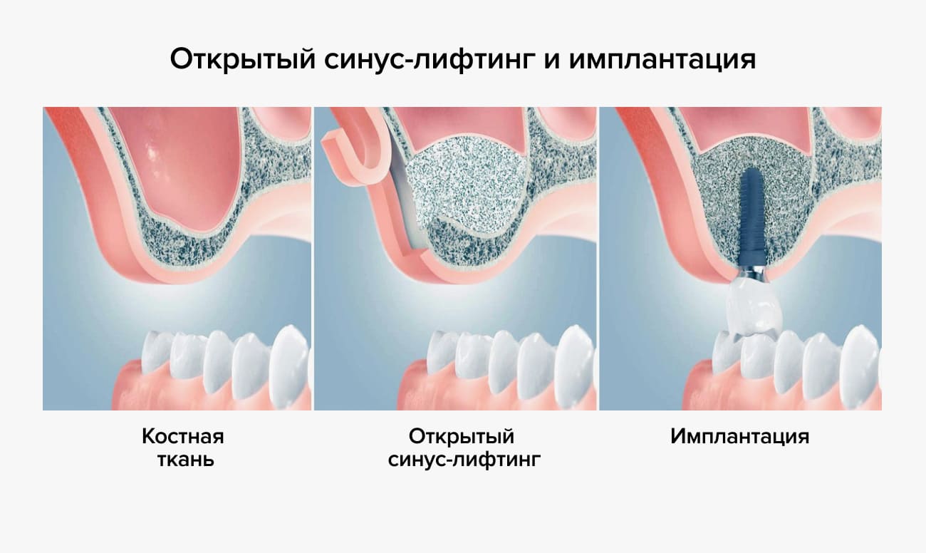 Презентация закрытый синус лифтинг