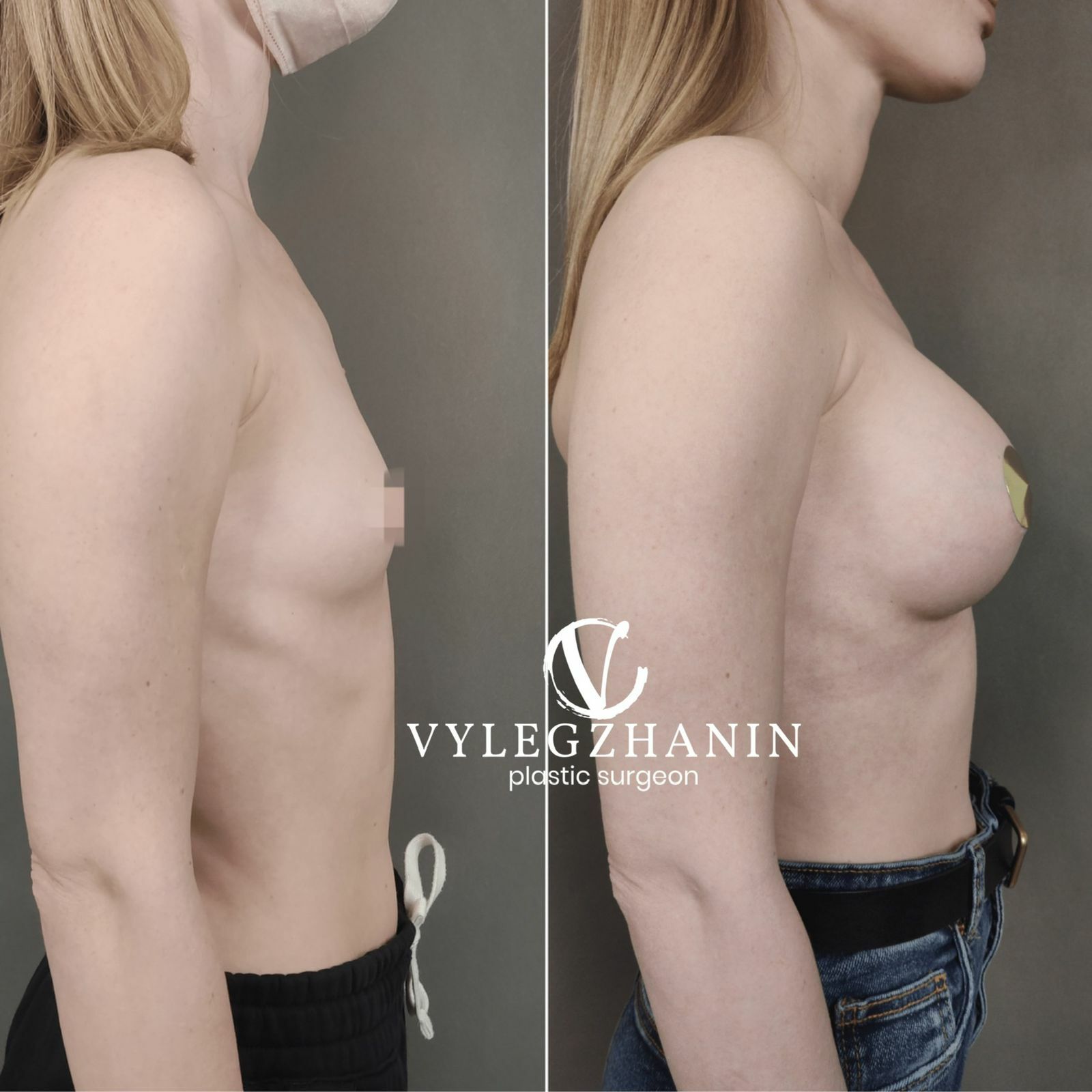удаление и восстановление груди в одну операцию фото 57