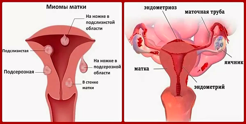 Основные симптомы у женщин при наличии миомы матки