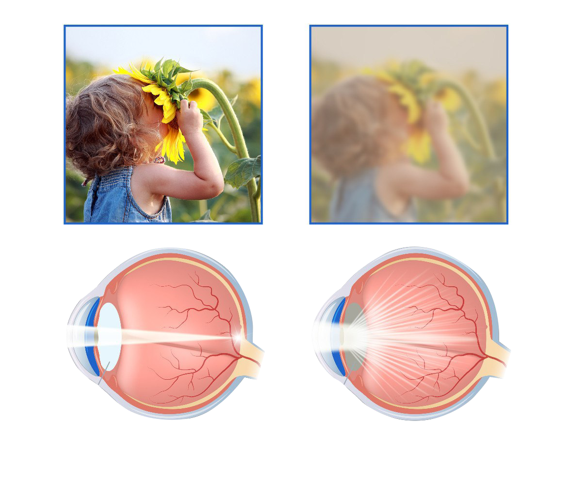 Почему мутно видно. Гиперметропический астигматизм у детей. Хрусталик глаза человека при катаракте. Спицевидная катаракта.