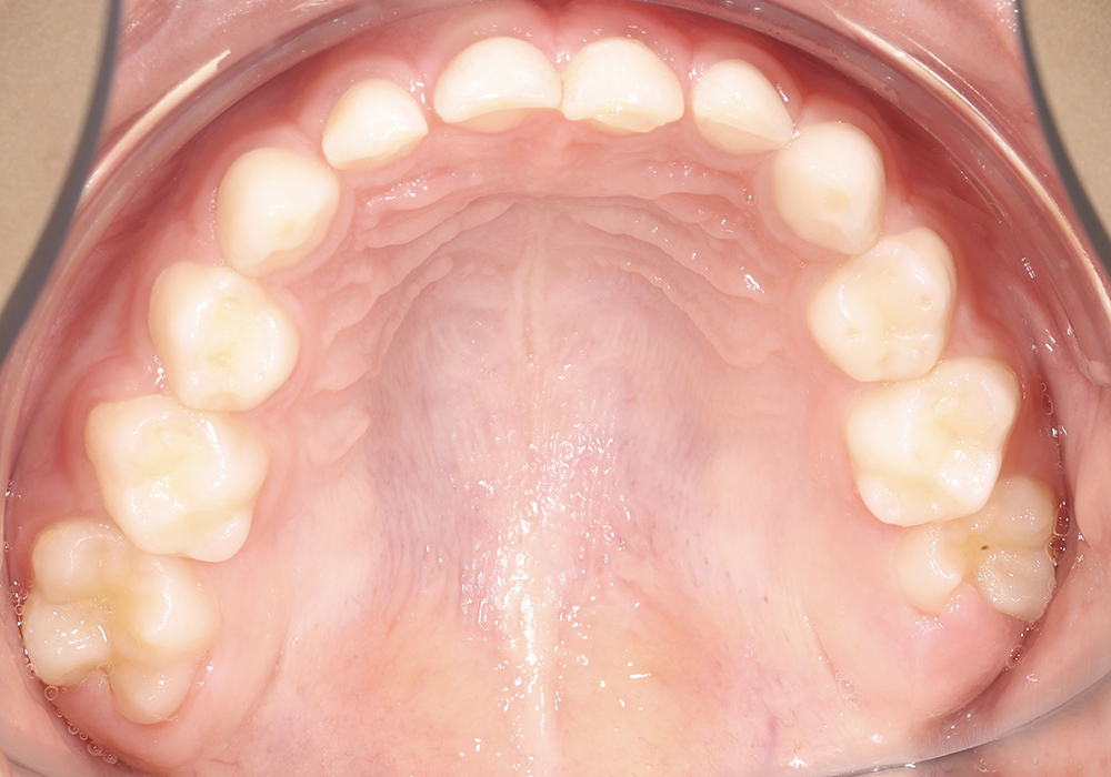 Исправление сужения зубных рядов аппаратом Хааса у пациента 7 лет