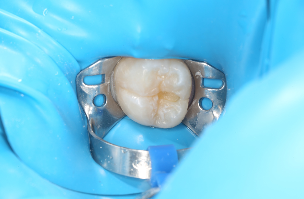 Восстановление жевательного зуба композитной пломбой с учётом анатомии и цвета эмали