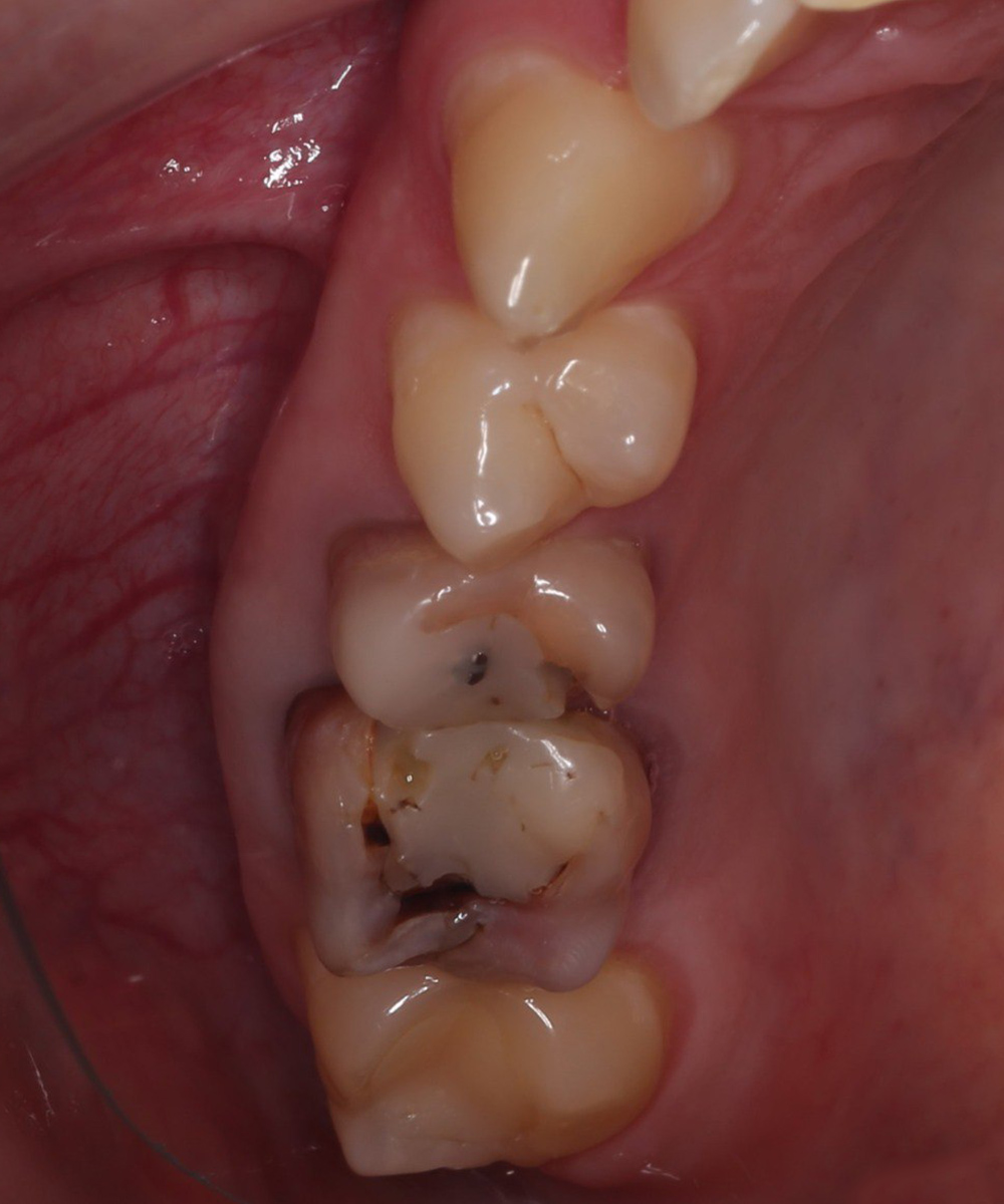 Сохранение зубов с дентальным микроскопом и установкой циркониевых коронок