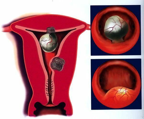 Субмукозная миома матки