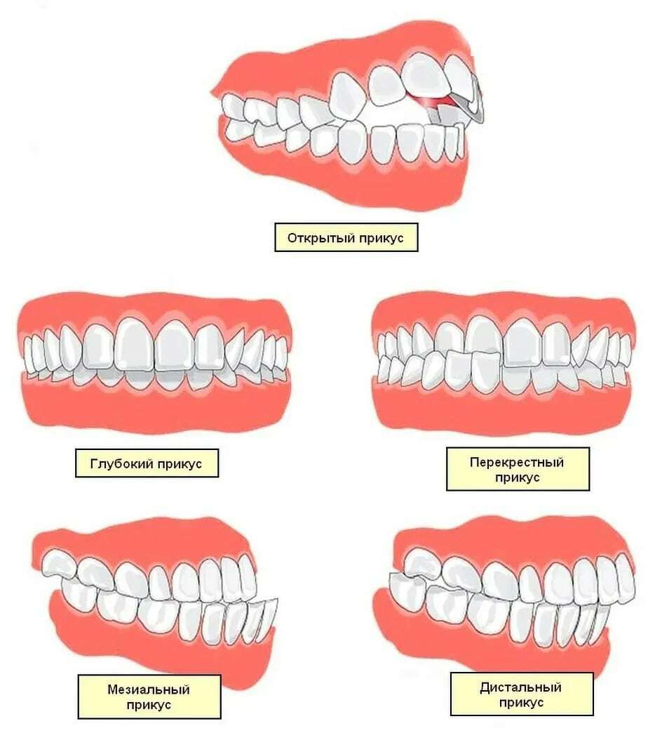 фото правильно поставленных зубов