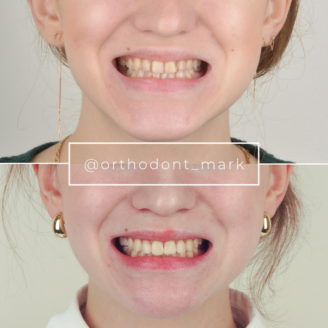 Skeletal Class III With Facial Asymmetry Resolved by Surgery