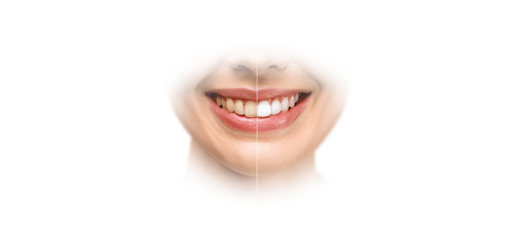 Отбеливание зубов Вологда | ИНБИО