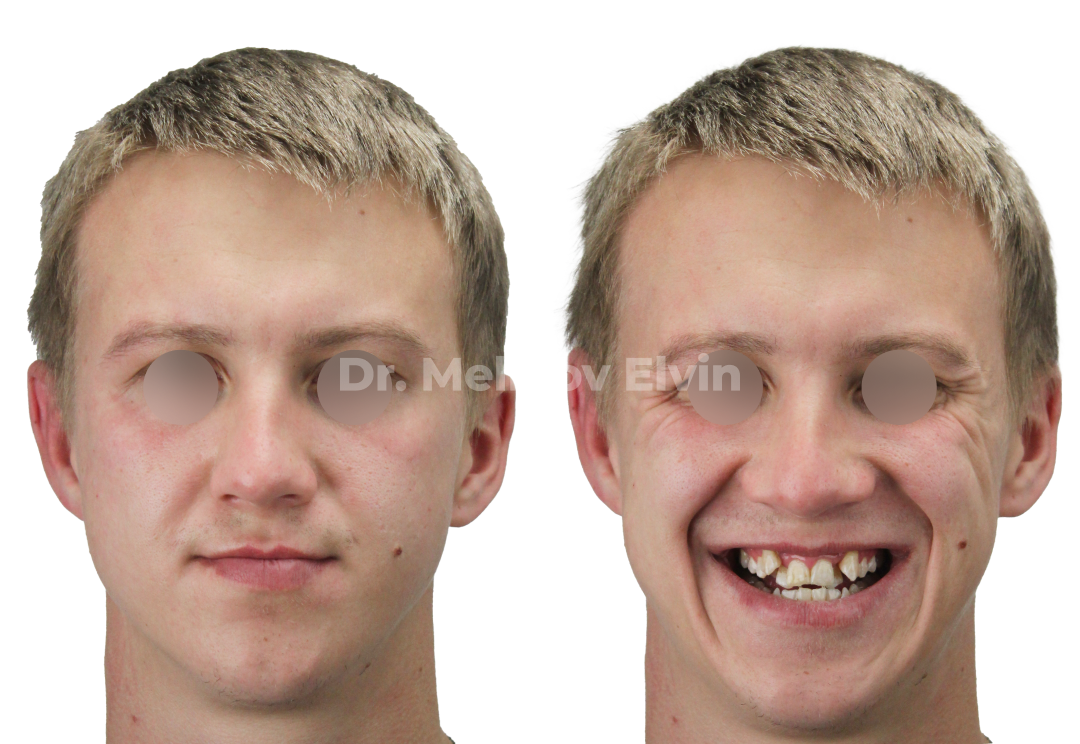 Фотографии до операции по расширению верхней челюсти.
