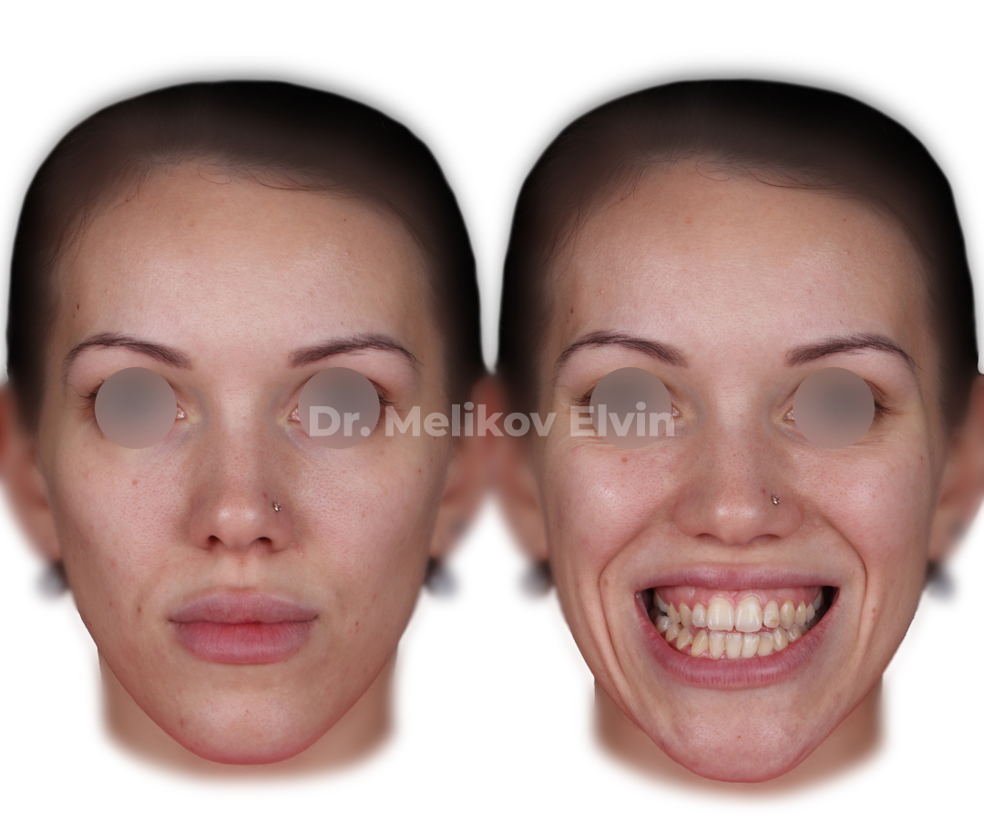 Мезиальный прикус