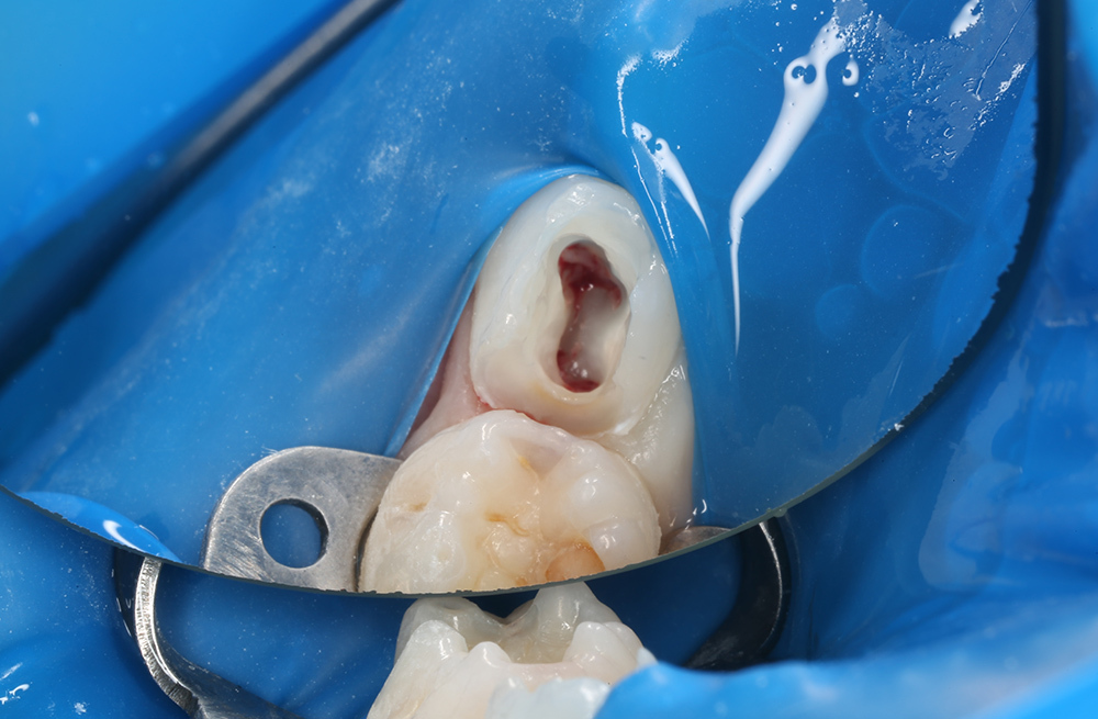 Восстановление молочного зуба с помощью коронки при пульпите