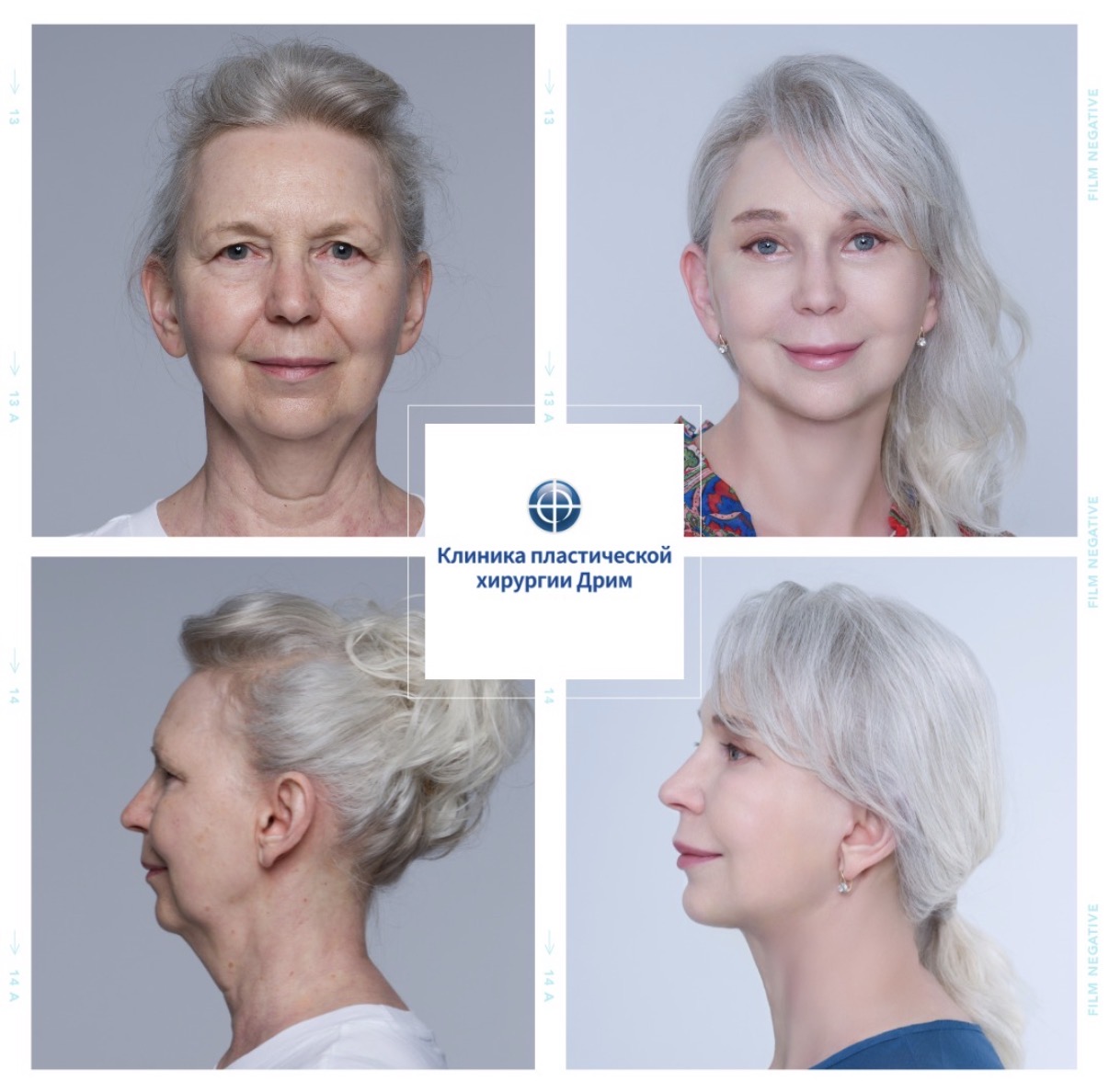 Before and after facelift results: elimination of jowls, restoration of a clear facial oval and cheek volume. An example of natural rejuvenation while preserving the patient's individual facial features.