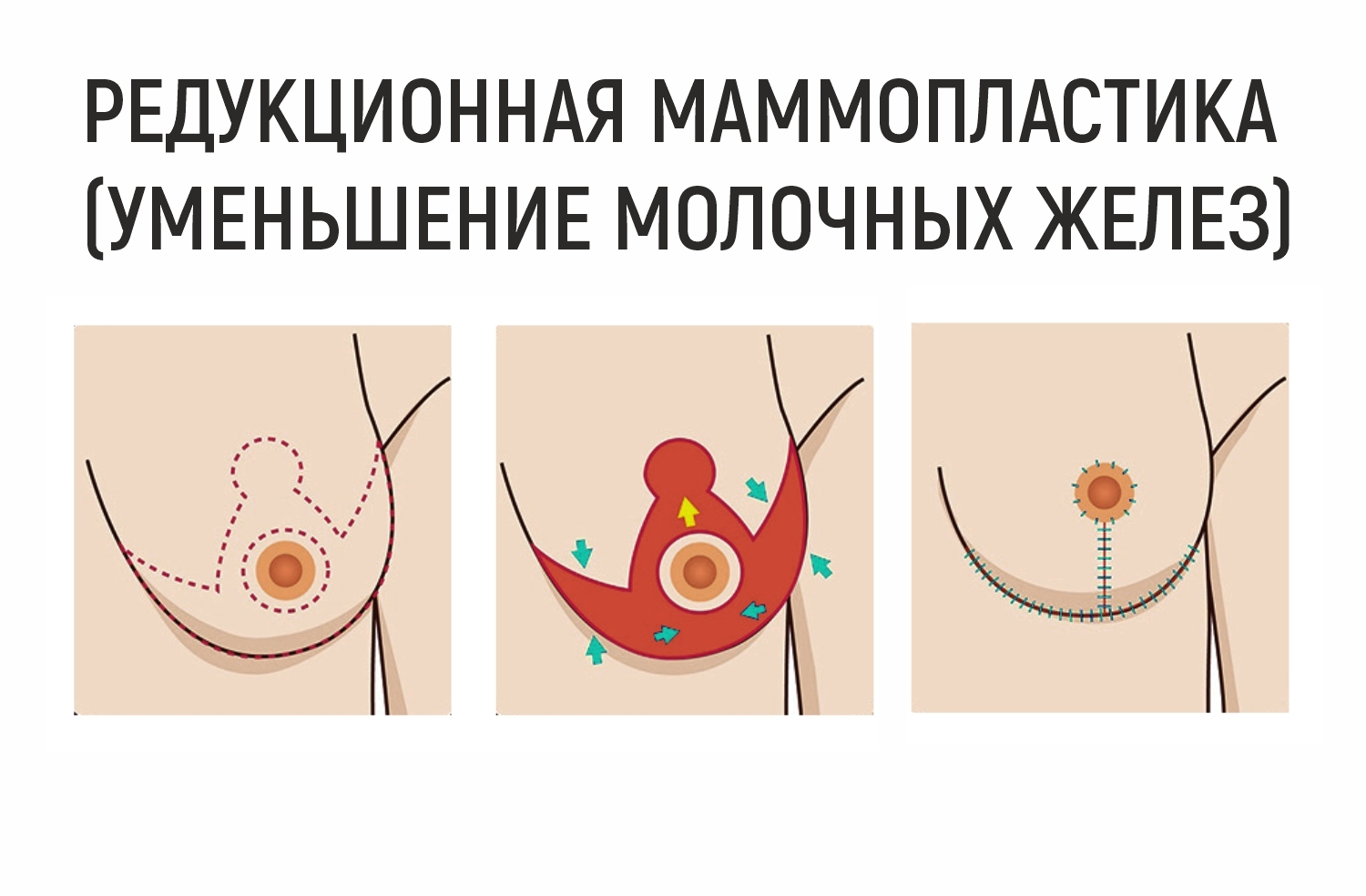 Как вставать с кровати после маммопластики