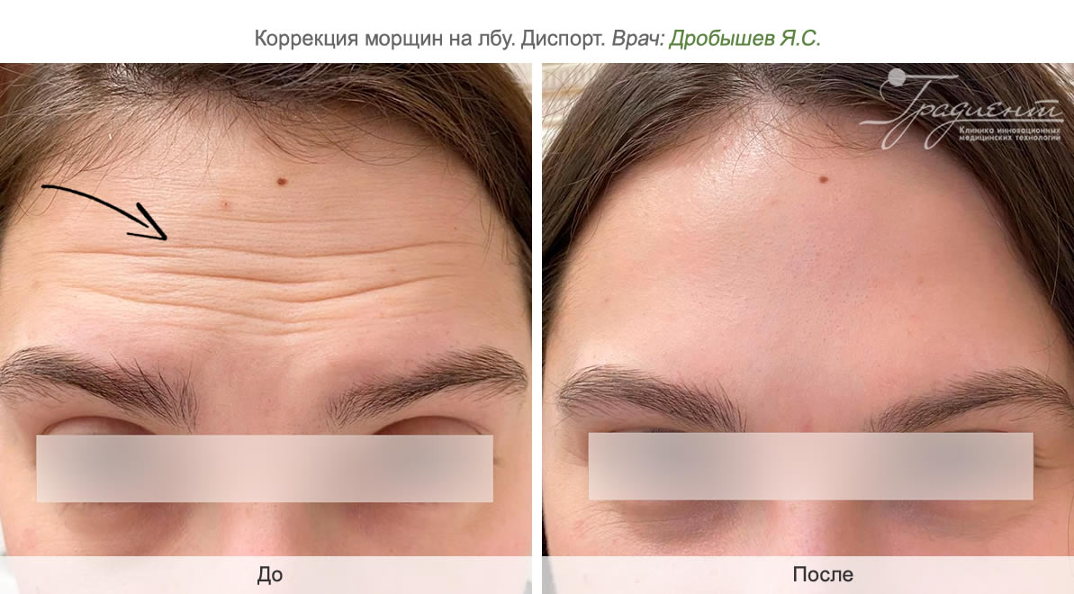 Коррекция морщин: мимических, вокруг глаз, носогубных и морщин на лбу в  клинике «Градиент» в Москве