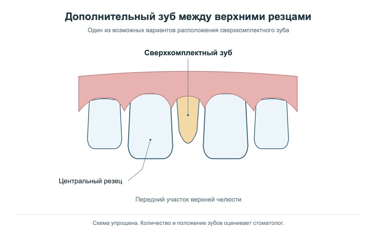 Схема расположения сверхкомплектного зуба