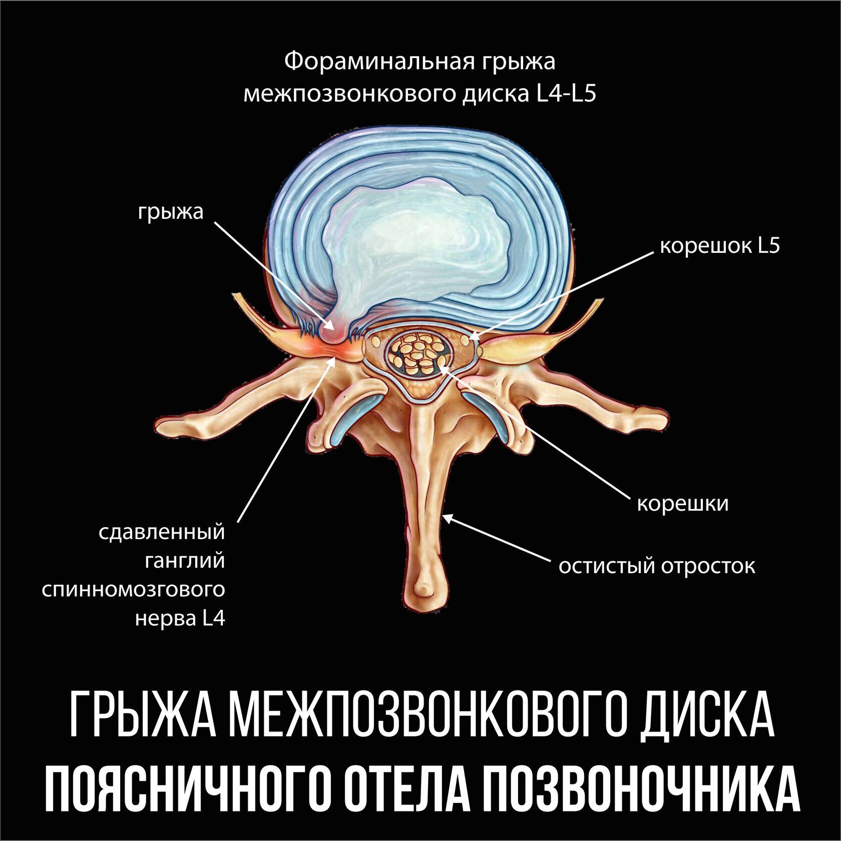 Трансфораминальная блокада корешка