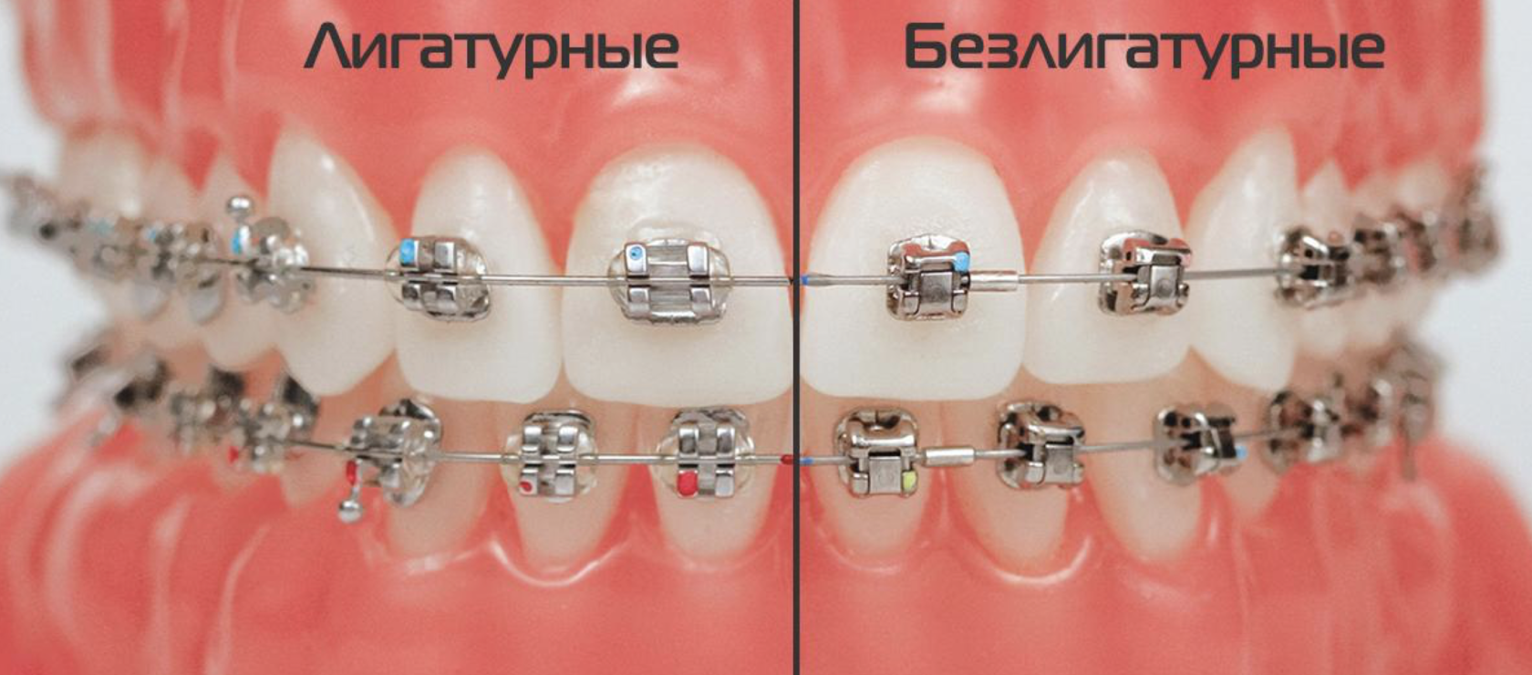 самолигирующие брекеты damon q2. лигатурные брекеты. самолигирующие (безлигатурные) брекеты. лигатурные и самолигирующие. безлигатурные системы брекеты.