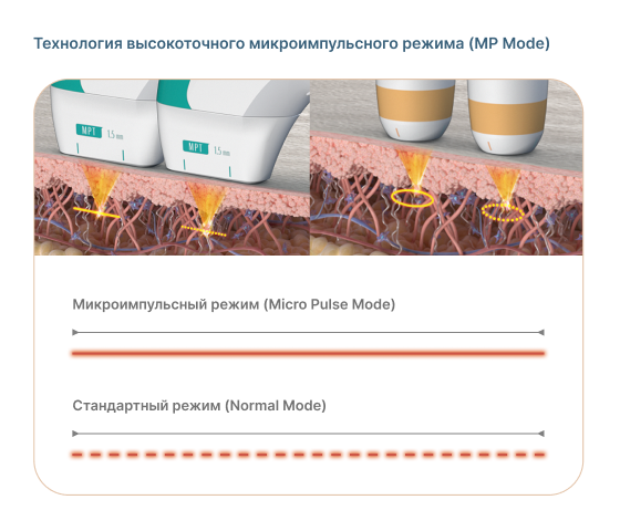Как работает Ultraformer MPT - технология MP Mode