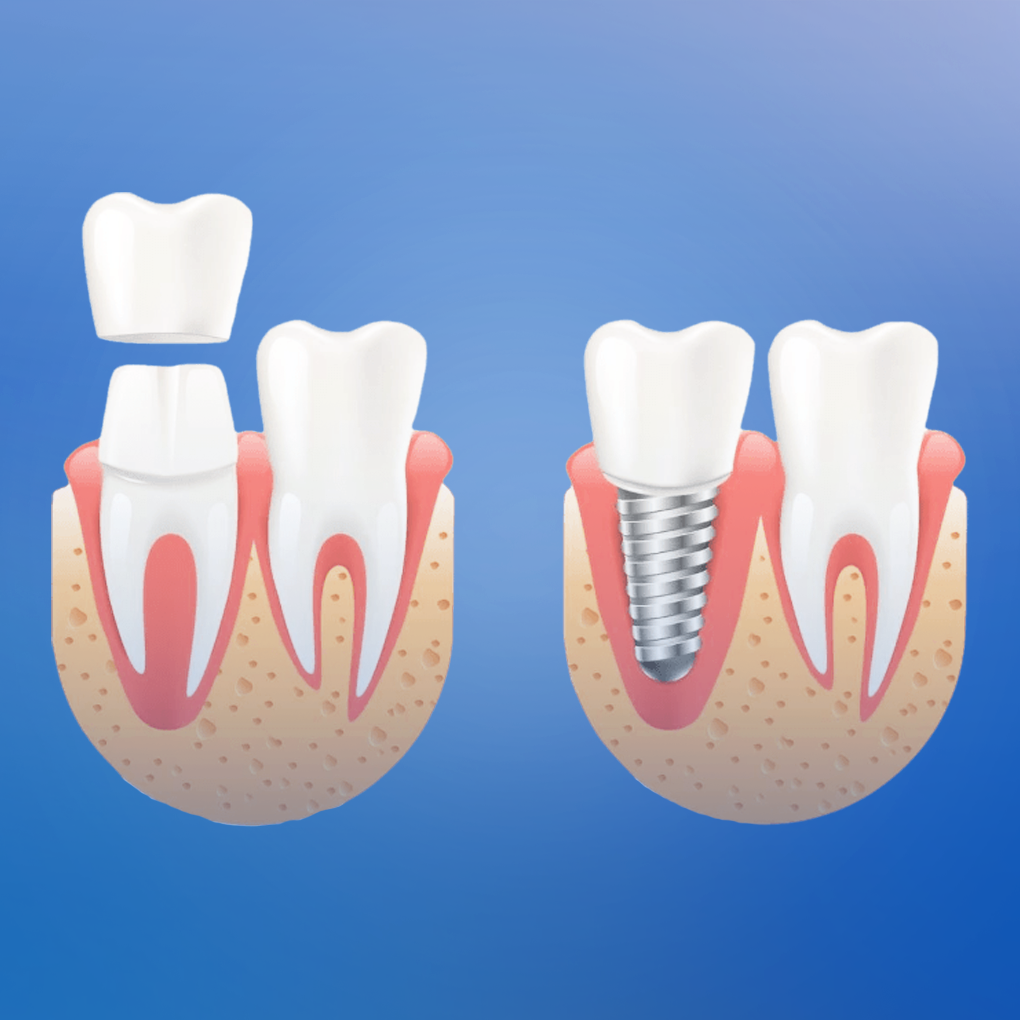 Чем отличается протезирование от имплантации зубов, зубные протезы, импланты
