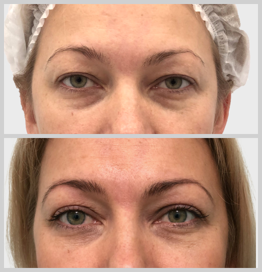 блефаропластика нависшие веки