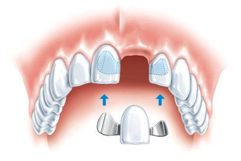 Установка зубных мостов на постоянный цемент