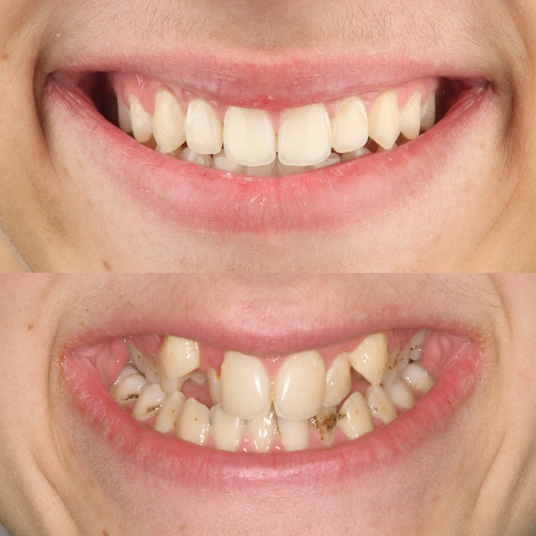 MARPE case result 5