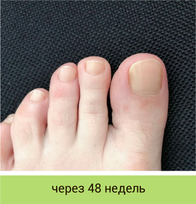 Миколепт® лак от грибка ногтей. Официальный сайт