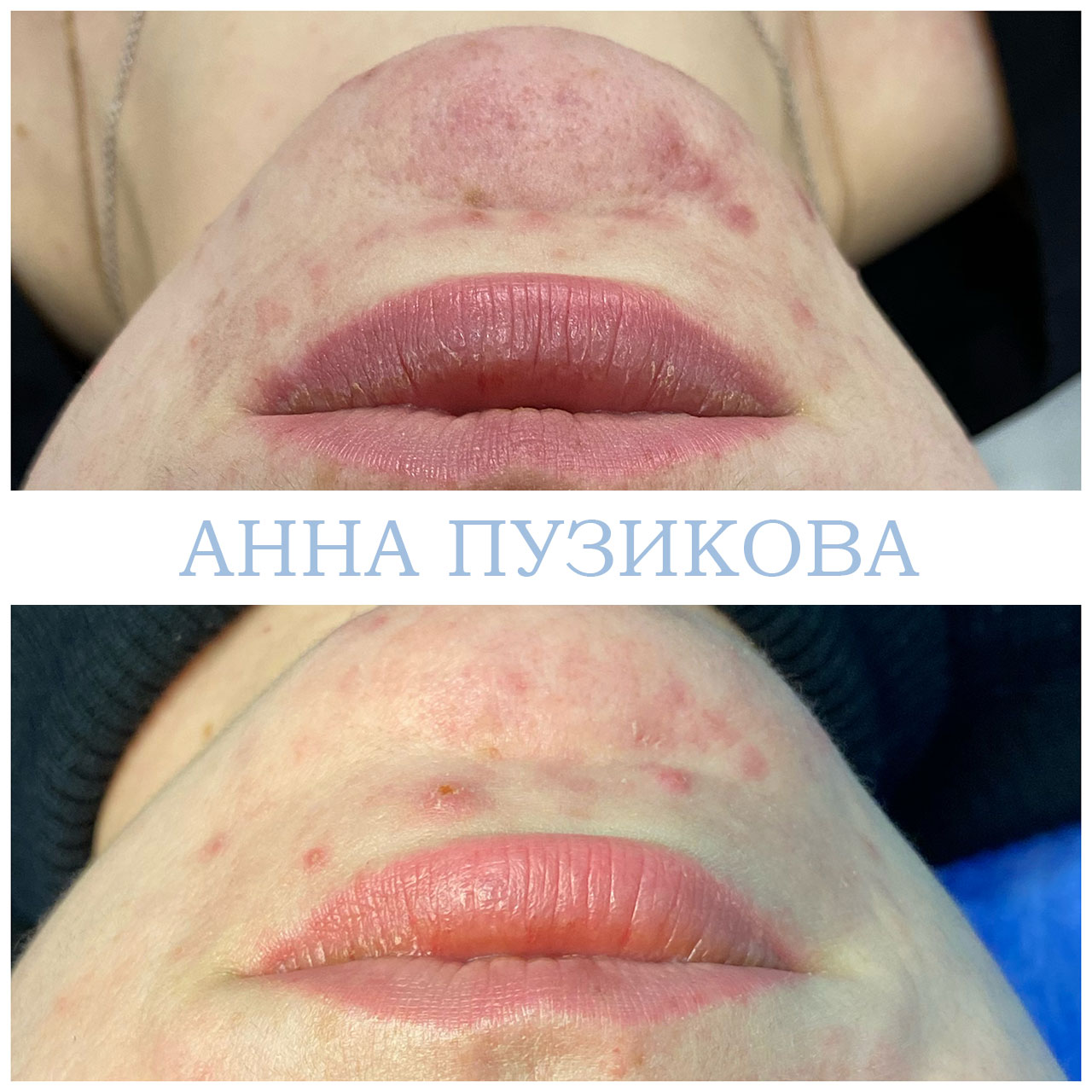 Результат лечения акне и воспалений кожи после курса процедур у косметолога Анны Пузиковой в клинике Прадус (СПб).