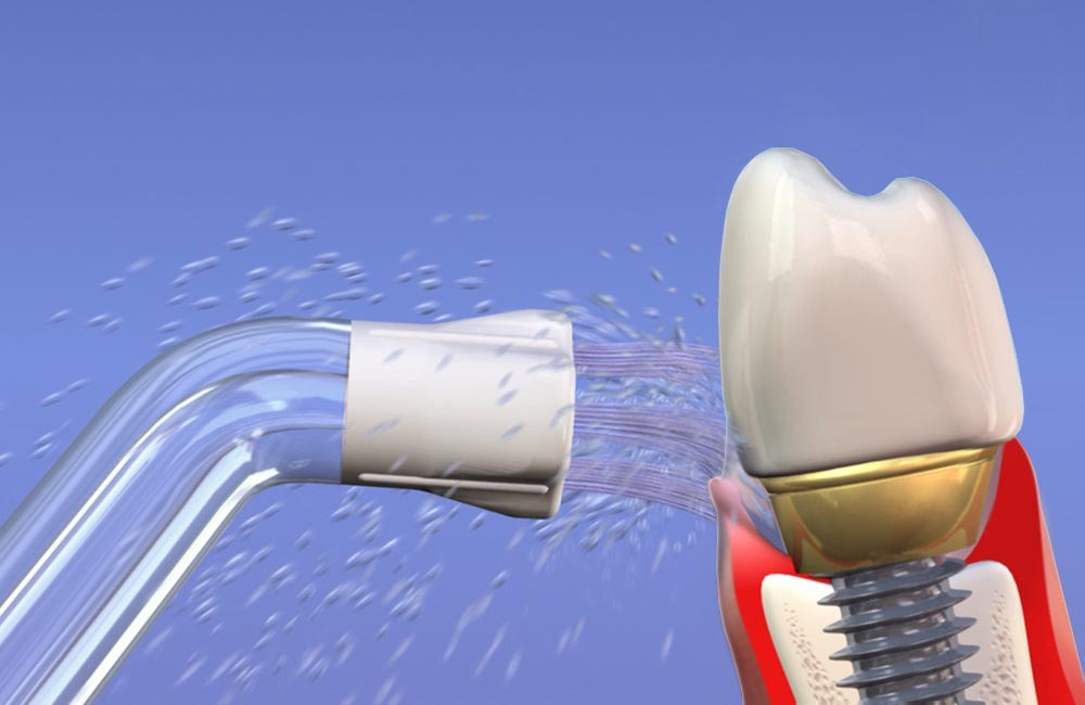 Уход за зубным имплантом: ключ к долговечности вашей улыбки