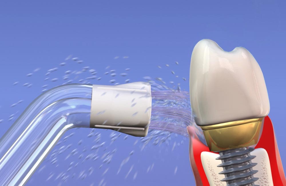 Ирригатор для полости рта после имплантации: ключ к быстрой и безопасной реабилитации