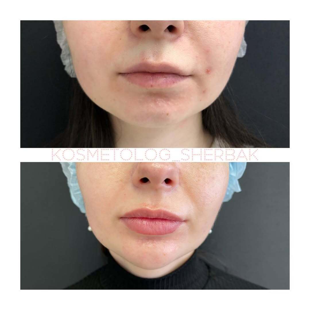 Контурная пластика лица в клинике PradusCOSMO, Санкт-Петербург. Естественный результат без эффекта переделанного лица