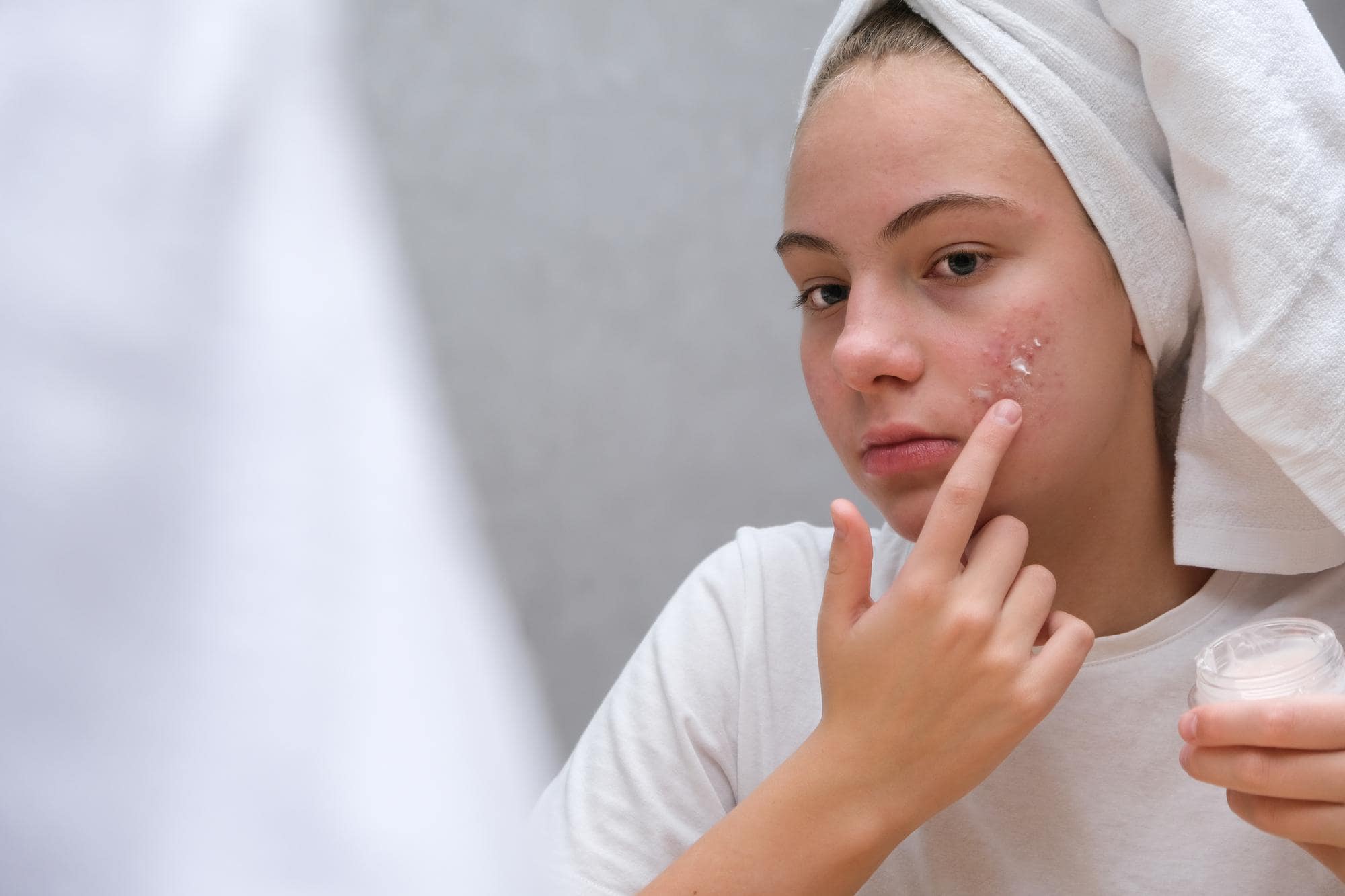 Dry and acne-prone skin - acne-solutions