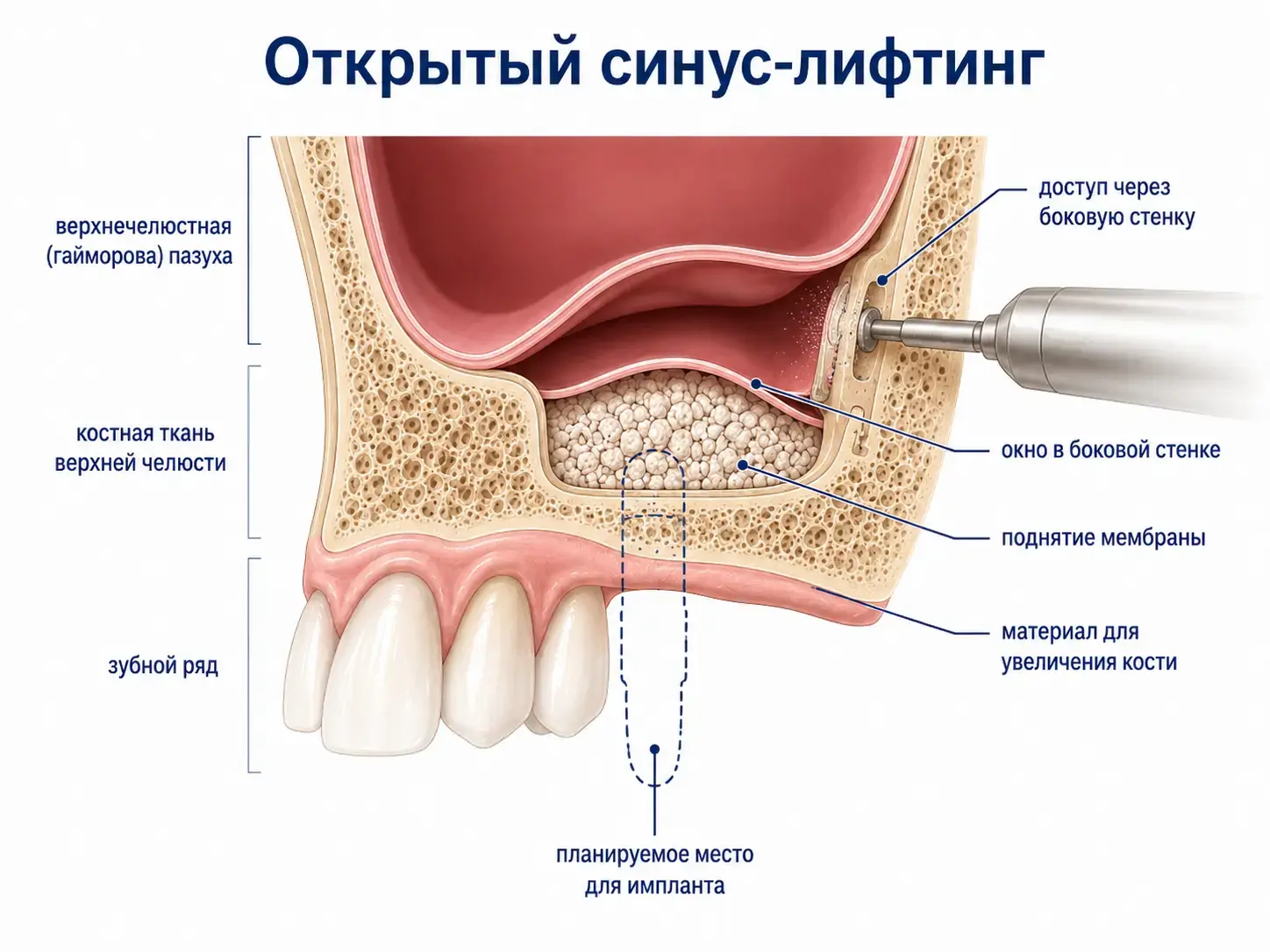 Открытый синус-лифтинг