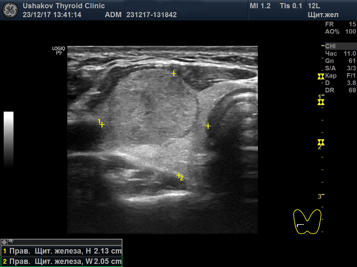 Узел щитовидной железы ti rads 3. УЗИ щитовидной железы ti-rads-3. Дополнительная долька щитовидной железы на УЗИ. ACR ti-rads. Добавочная доля щитовидной железы на УЗИ.